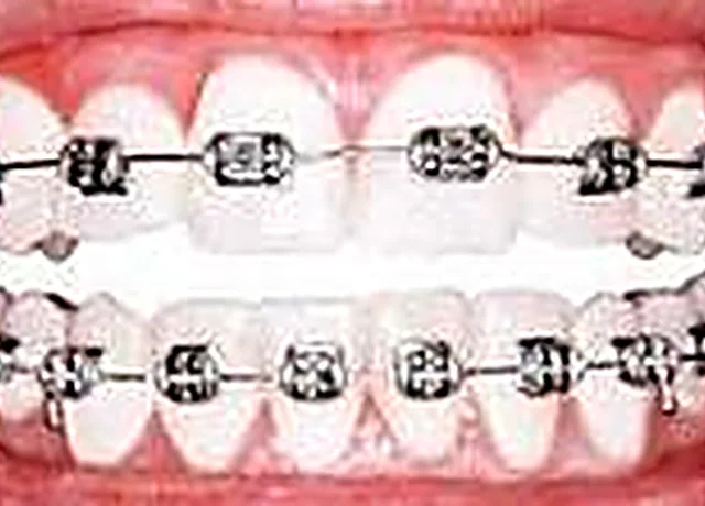 Wisdom teeth and oral surgery consultation at Easy Dental Care Center in Norcross, GA