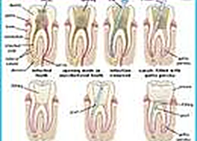 Root canal and filling treatment at Easy Dental Care Center in Norcross, GA