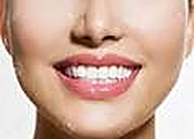 Professional teeth whitening at Easy Dental Care Center in Norcross, GA